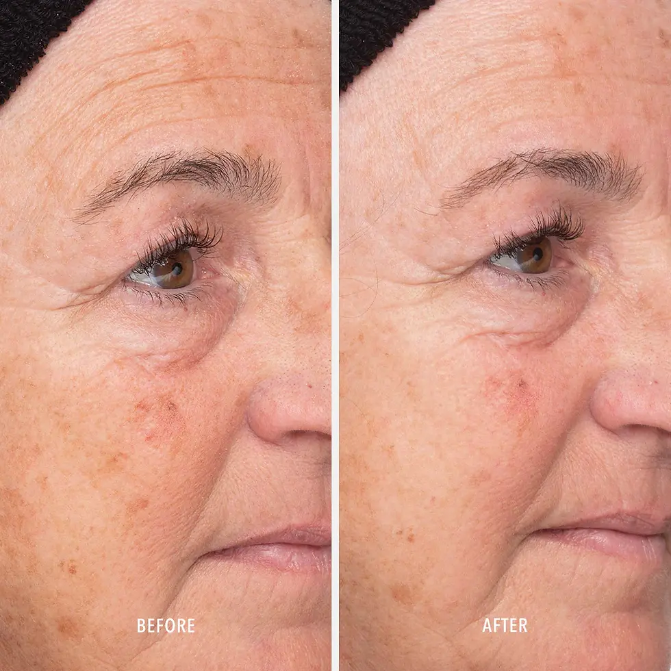Miniature : Liquid Resurfacing Solution