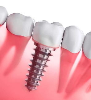 Implante dentário