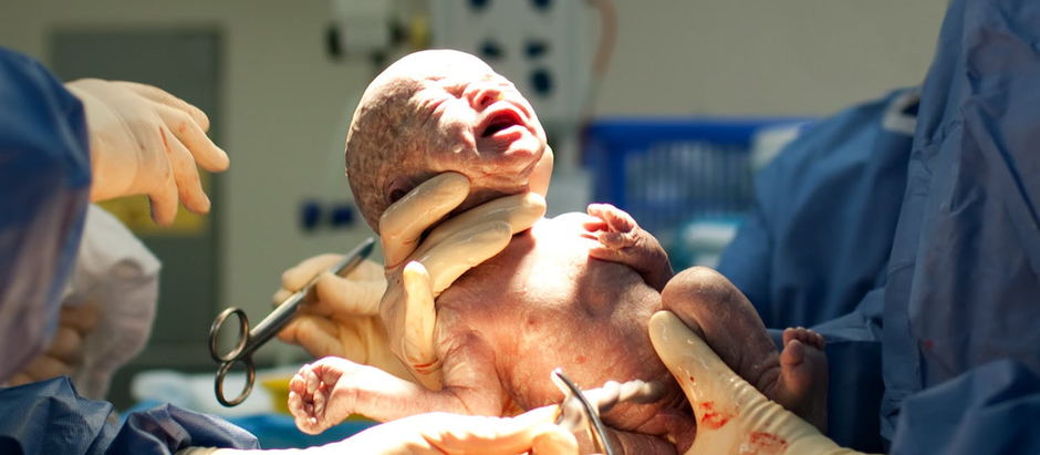 How a Doula Supports Both Mother and Partner During a C-Section Birth