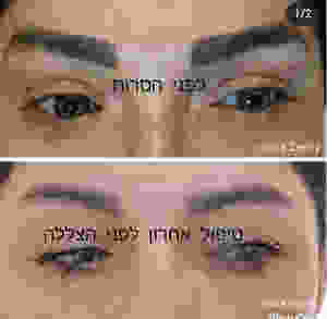 הסרת איפור קבוע - שירה זאבי