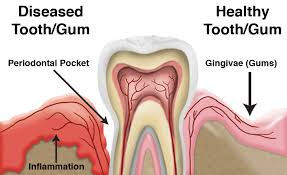 Gum Diseases Mouth Demon