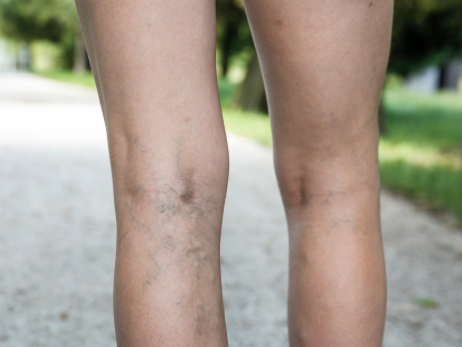 Doctor examining varicose veins on patient's leg at vein clinic in Arlington TX