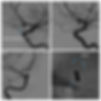 Stent assisted coils.jpg