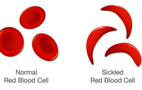 Recent Gene Therapies for Sickle Cell Disease