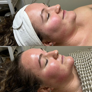 Before and After Signature Facial