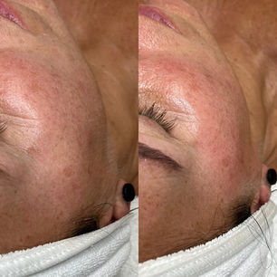 Before and After Dermaplaning
