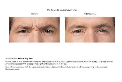 Botox