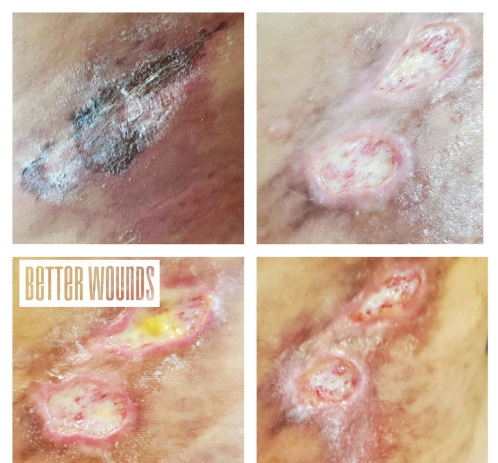 Lipo Burn Evolution