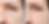 Botox Under Eyes before and after