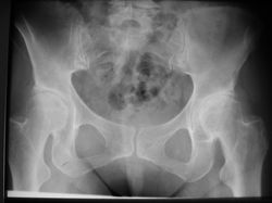 Coxarthrose bei Hüftdysplasie