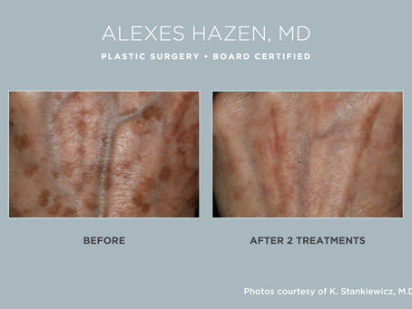 Cutera Excel V+ Laser: A Powerful Solution for Skin Rejuvenation