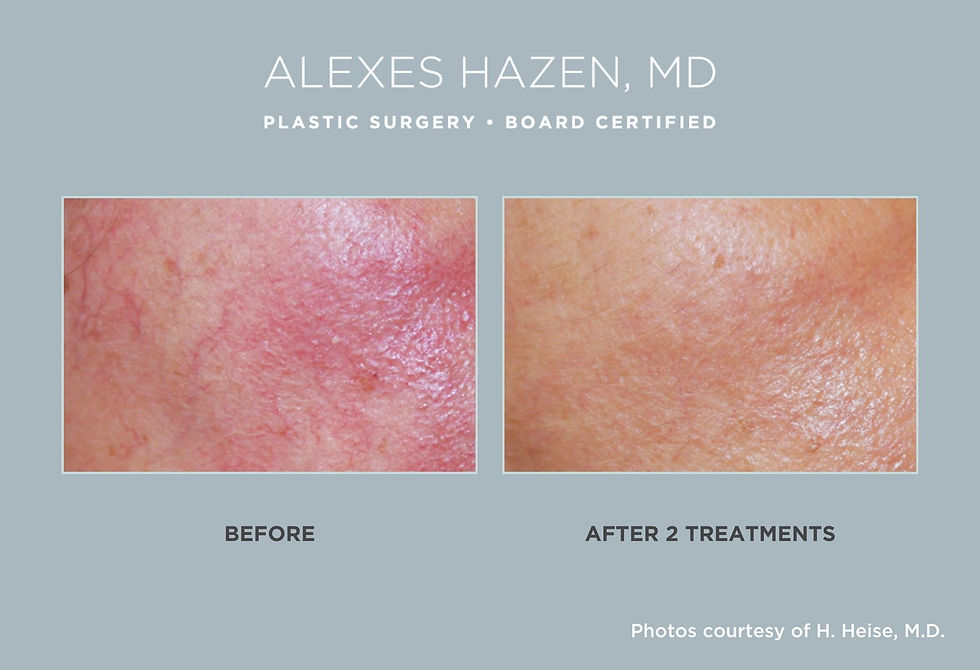 cutera excel V+ Laser treatment before and after small vein removal