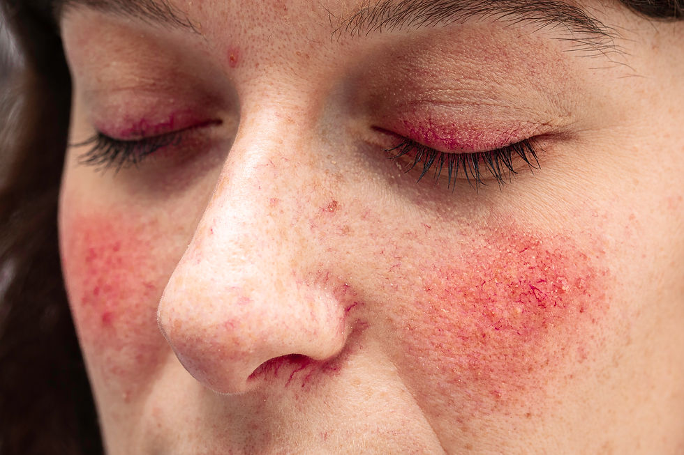 close-up-view-face-young-caucasian-lady-suffering-from-severe-case-rosacea.jpg