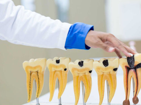 Precautions After Undergoing Root Canal