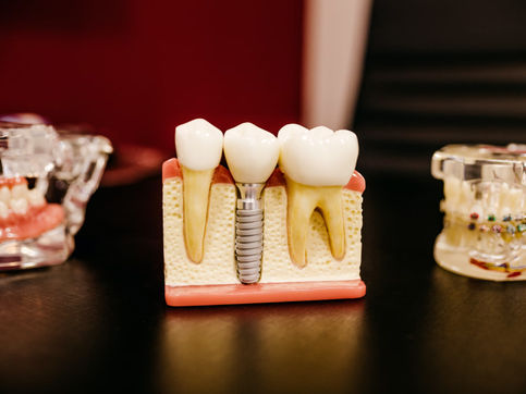 How To Tell If You Need A Root Canal Or A Crown