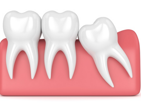 Know More About Wisdom Teeth Removal and Dental Implants