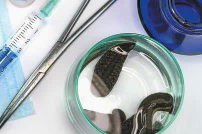 Medicinal Leech Therapy