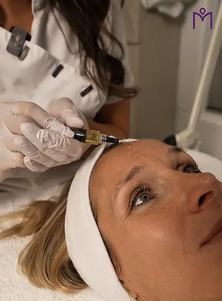 peeling-medipraxis-dordrecht-tca-kruidenpeeling-
