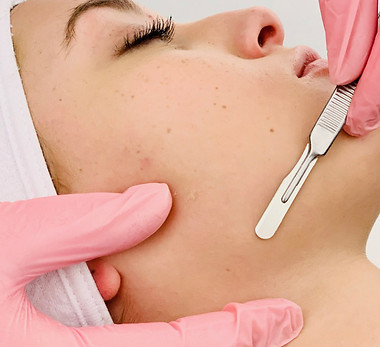 dermaplaning littleton