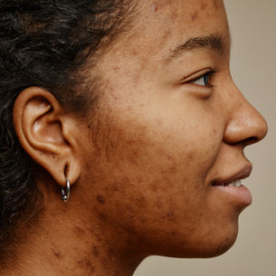 Clear Skin Starts from Within: My Inside-Out Approach to Acne