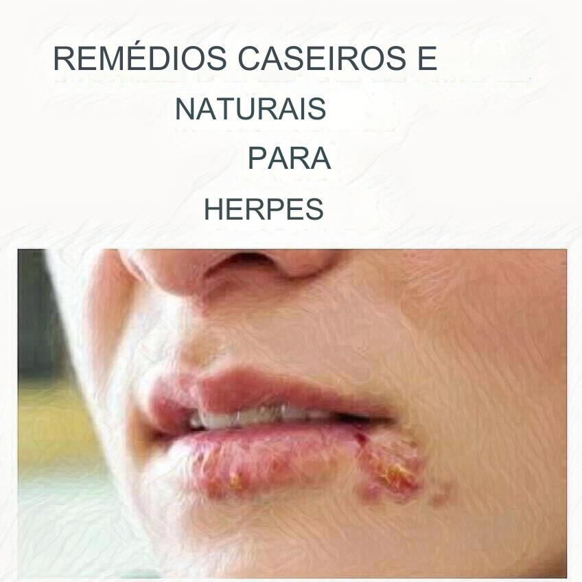 Herpes e Tratamentos Naturais