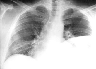 L diaphragm.jpg