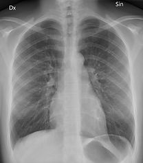 Normal_posteroanterior_(PA)_chest_radiog