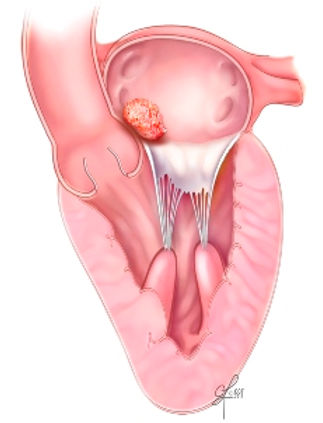 cardiac-tumors-atrial-myxoma-sm.jpg