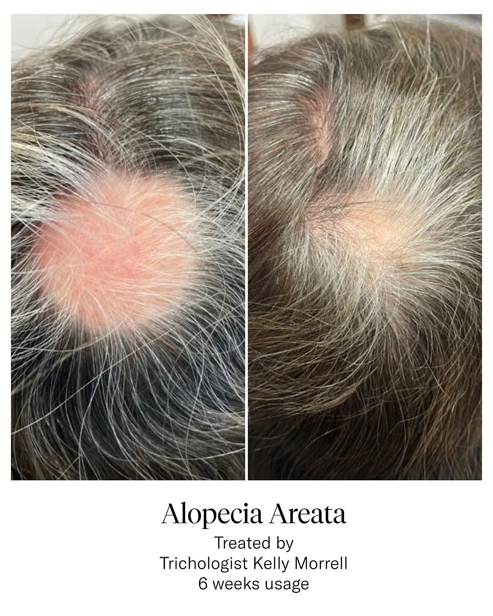 Alopecia Areata