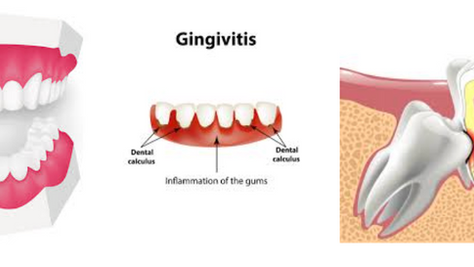 Oral Health Challenges Worldwide: Causes, Treatments, and Inequities in Managing Bruxism, Gingivitis, and Impacted Teeth