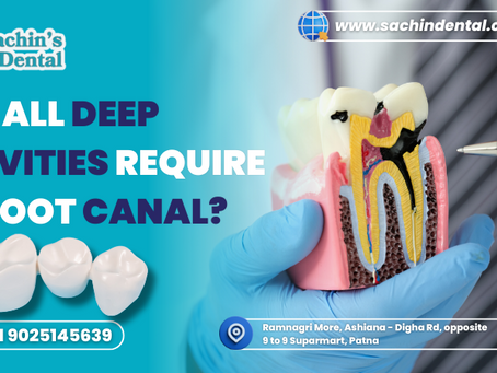 Do All Deep Cavities Need Root Canal Procedure? - Truth Revealed! 