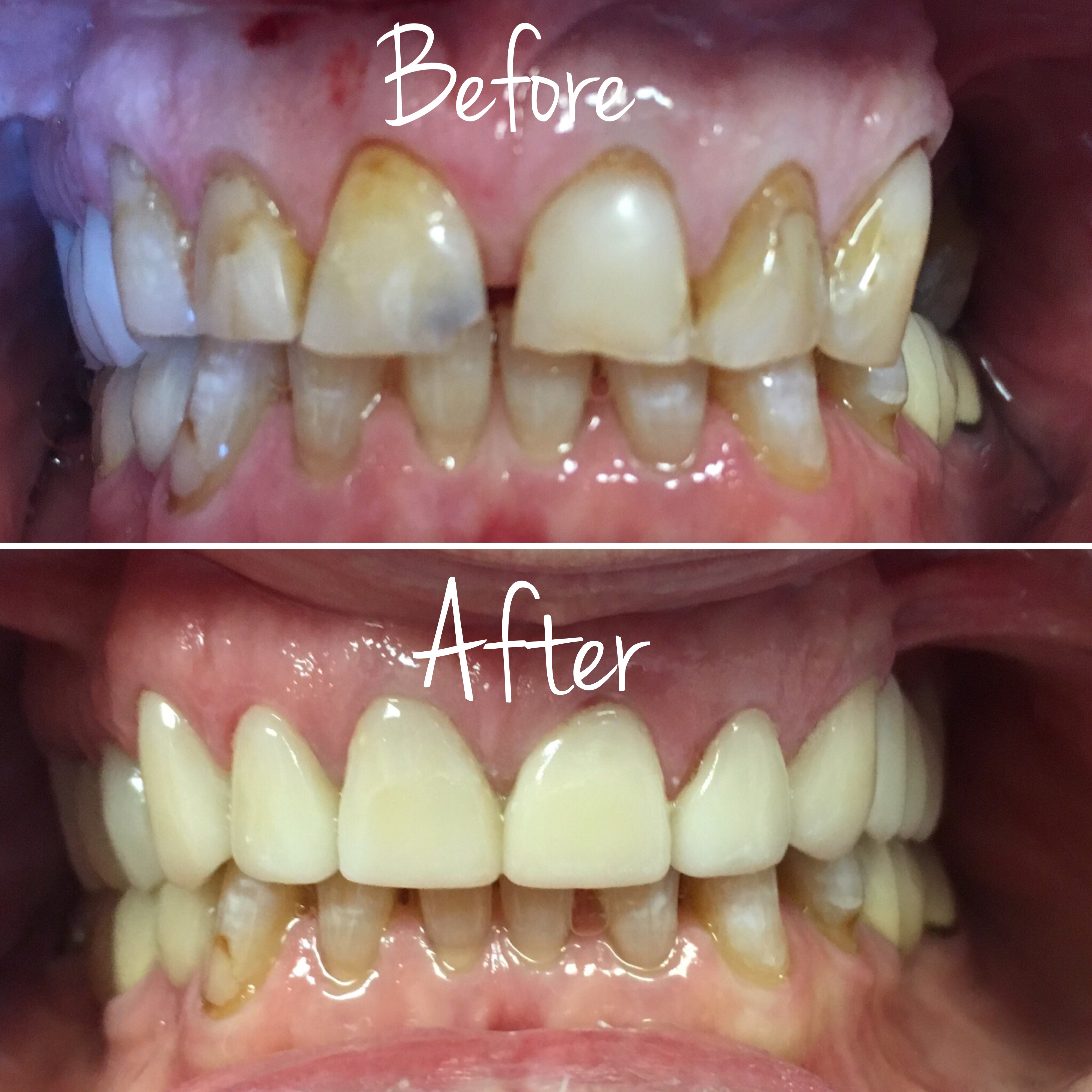Porcelain crowns and bridge