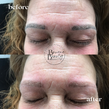 Eyebrow removal