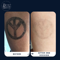 "tattoo removal near me"