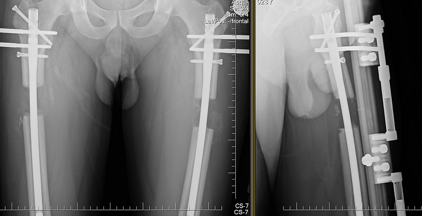 X-ray of limb lengthening surgery Turkey with rods.