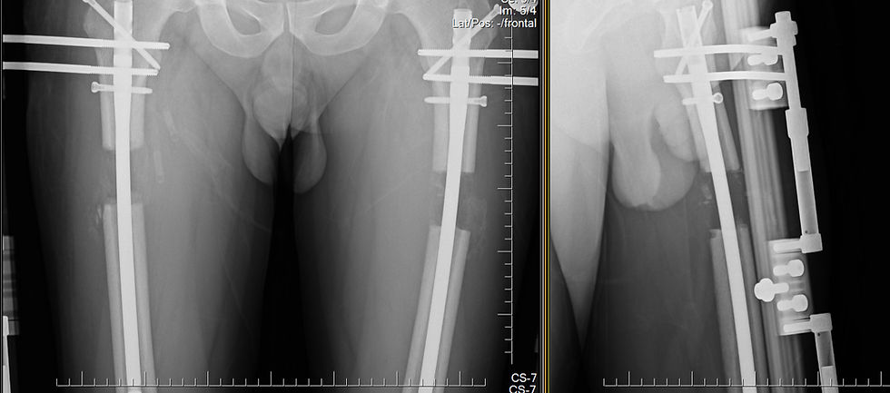 X-ray of limb lengthening surgery Turkey using rods