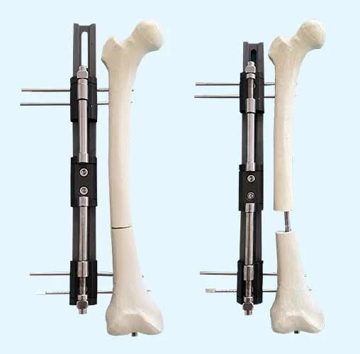 External fixator for limb lengthening surgery Turkey