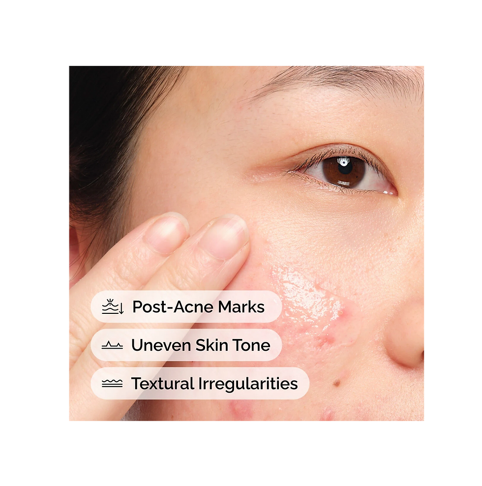Thumbnail: The Ordinary Aloe 2% + NAG 2% Solution 30ml for Post-Acne Mark Reduction