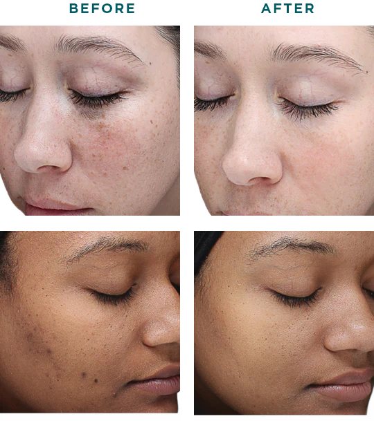 VI Peel Original Before And After photo