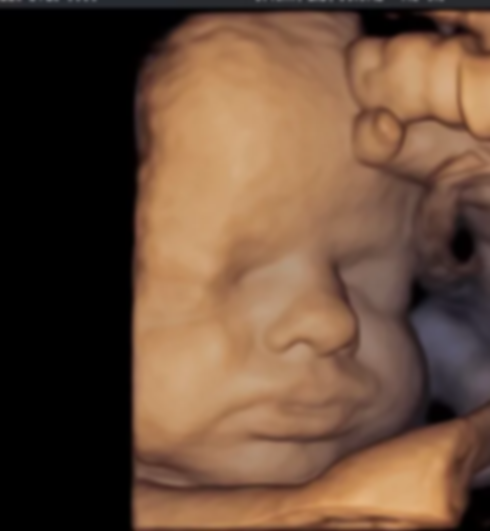 Diagnosi prenatale non invasive