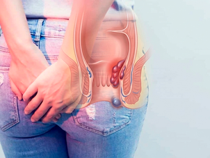 Atenção: hemorroida não se resolve sozinha!