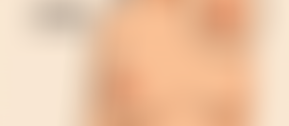 Capezzolo retratto o introflesso? Scopri quando può essere un segnale di tumore al seno, quali sintomi osservare e quando consultare un senologo. Approfondisci cause, diagnosi e prevenzione.