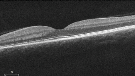uveitis_20_6.png