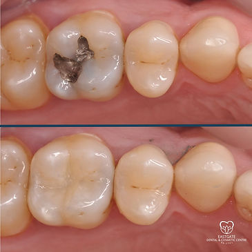Before and after filling eastgate dental bristol (Instagram Post (Square)).jpg