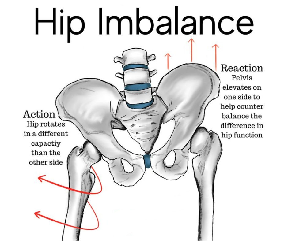 Anatomical illustration showing hip imbalance and uneven femur positioning in the hip socket due to leg misalignment.