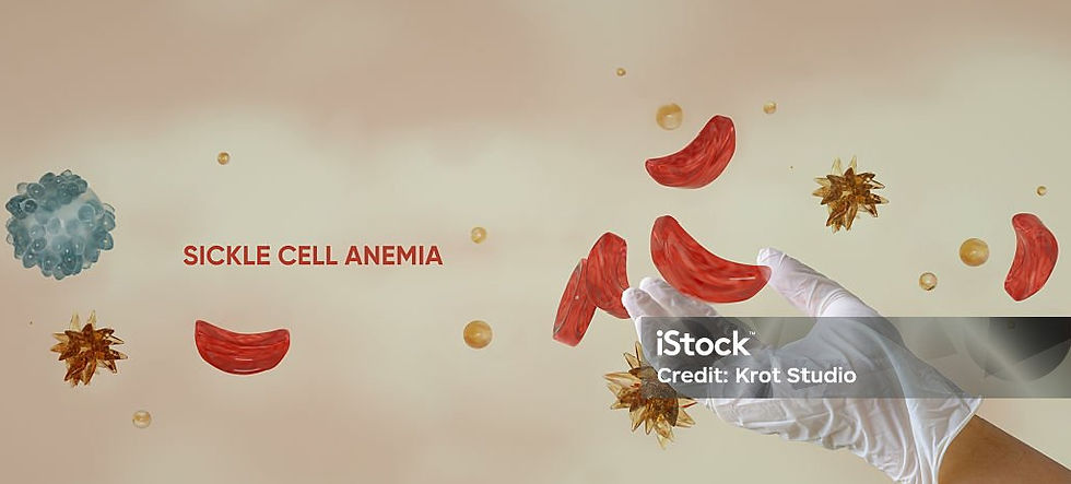 Sickle Cell Anaemia: The Unseen Crisis
By Hamu Madzedze