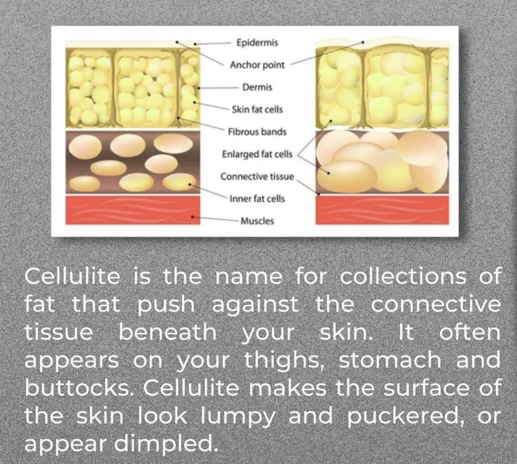 Whtas Cellulite Cellulite: What is it and how can it be treated