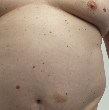 Melanoma2.jpg