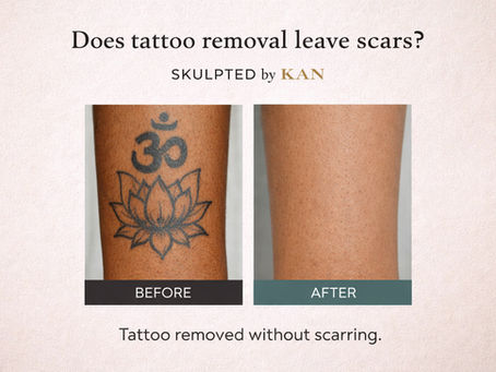 Does Tattoo Removal Leave Scars? What You Need to Know...