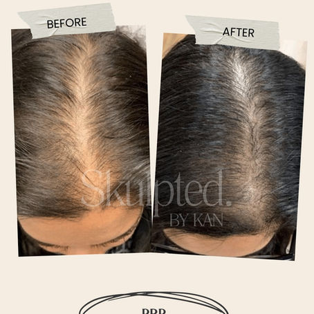 How Rohan Regained His Confidence with PRP Hair Therapy at Skulpted by KAN